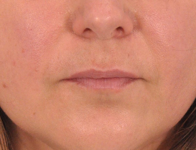 Lip Lift Before & After Gallery - Patient 349061 - Image 1