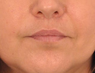 Lip Lift Before & After Gallery - Patient 349061 - Image 2