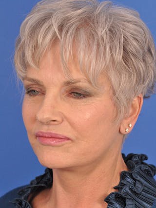 Blepharoplasty Before & After Gallery - Patient 545818 - Image 4