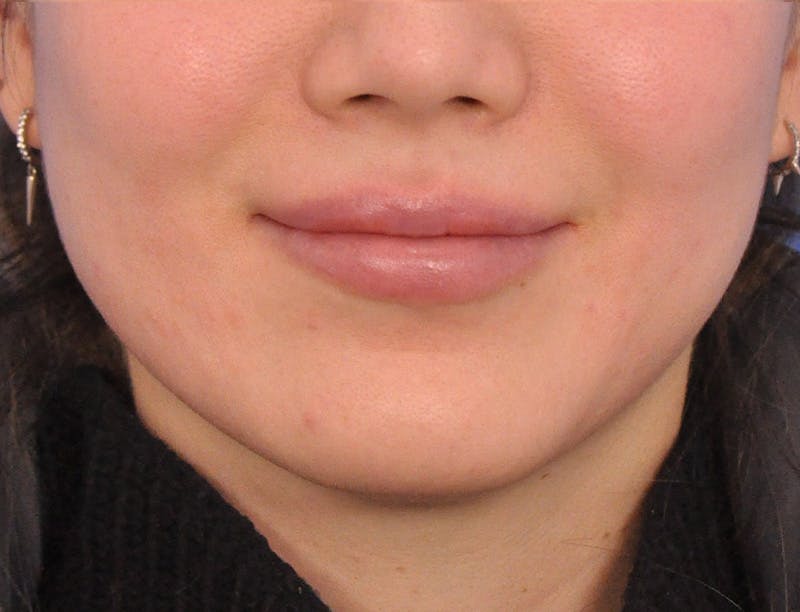Lip Lift Before & After Gallery - Patient 380555 - Image 3