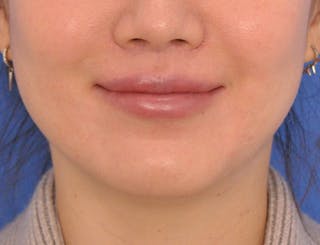 Lip Lift Before & After Gallery - Patient 380555 - Image 4