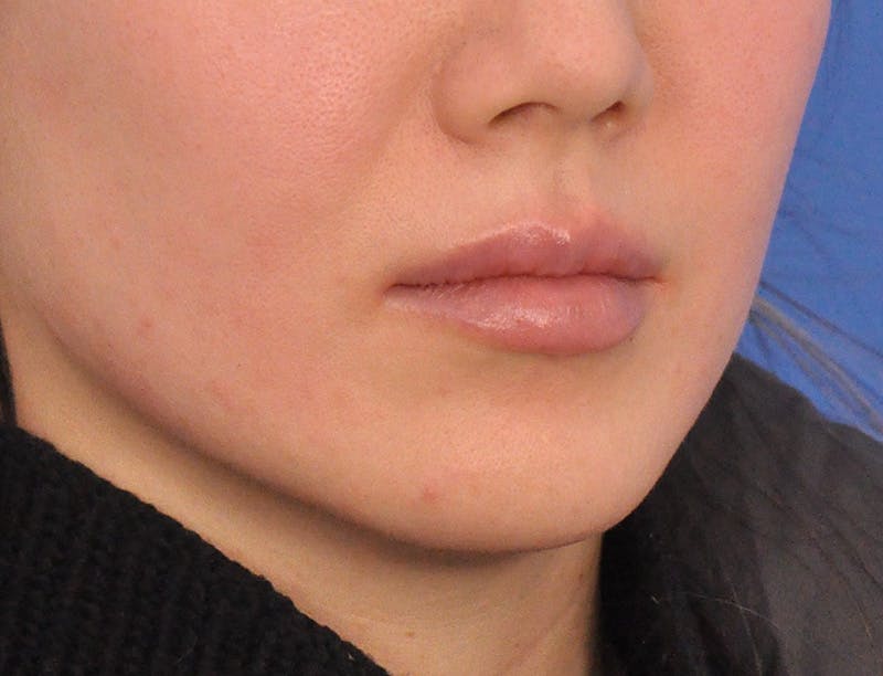 Lip Lift Before & After Gallery - Patient 380555 - Image 5