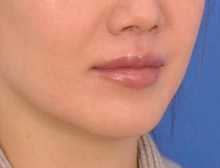 Lip Lift Before & After Gallery - Patient 380555 - Image 6