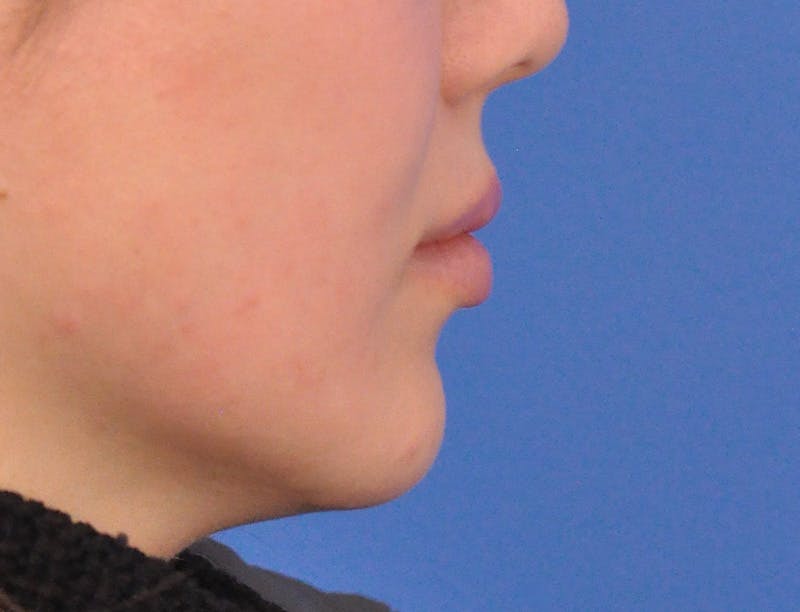 Lip Lift Before & After Gallery - Patient 380555 - Image 7