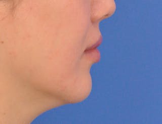 Lip Lift Before & After Gallery - Patient 380555 - Image 8