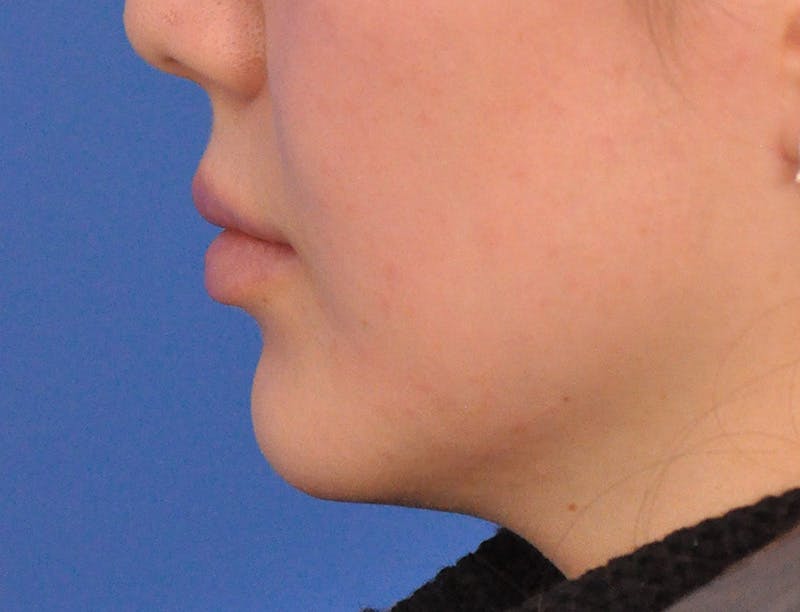 Lip Lift Before & After Gallery - Patient 380555 - Image 9