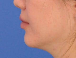 Lip Lift Before & After Gallery - Patient 380555 - Image 10
