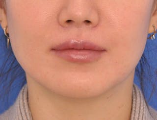 Lip Lift Before & After Gallery - Patient 380555 - Image 2