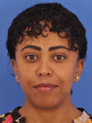 Blepharoplasty Before & After Gallery - Patient 180557 - Image 2