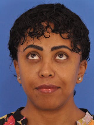 Blepharoplasty Before & After Gallery - Patient 180557 - Image 4