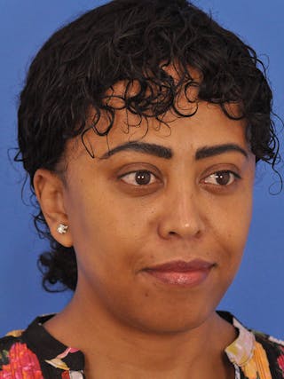 Blepharoplasty Before & After Gallery - Patient 180557 - Image 6