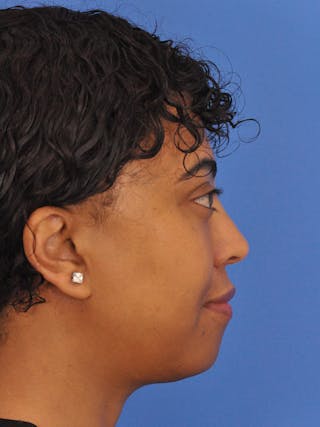 Blepharoplasty Before & After Gallery - Patient 180557 - Image 8