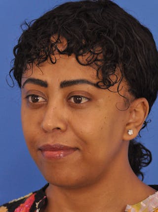 Blepharoplasty Before & After Gallery - Patient 180557 - Image 10