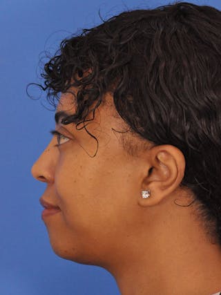 Blepharoplasty Before & After Gallery - Patient 180557 - Image 12