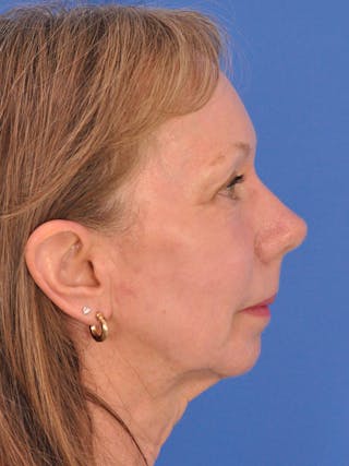 CO2RE Laser Before & After Gallery - Patient 425924 - Image 6