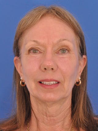 CO2RE Laser Before & After Gallery - Patient 425924 - Image 2