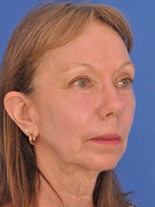 CO2RE Laser Before & After Gallery - Patient 425924 - Image 4