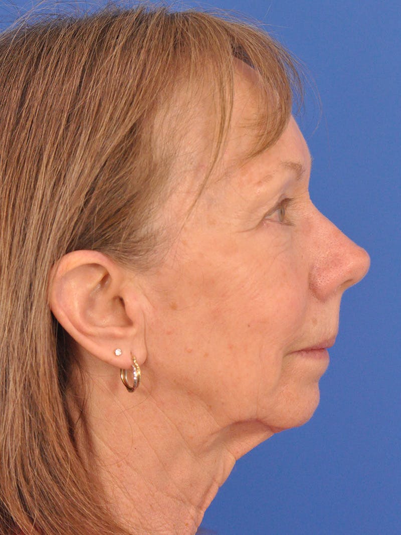 CO2RE Laser Before & After Gallery - Patient 425924 - Image 5