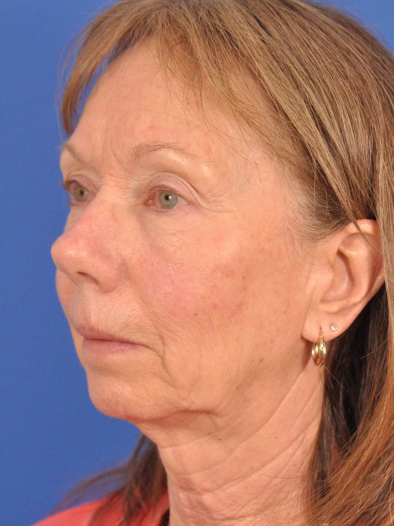CO2RE Laser Before & After Gallery - Patient 425924 - Image 7
