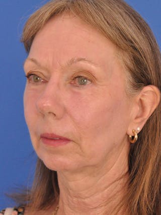 CO2RE Laser Before & After Gallery - Patient 425924 - Image 8