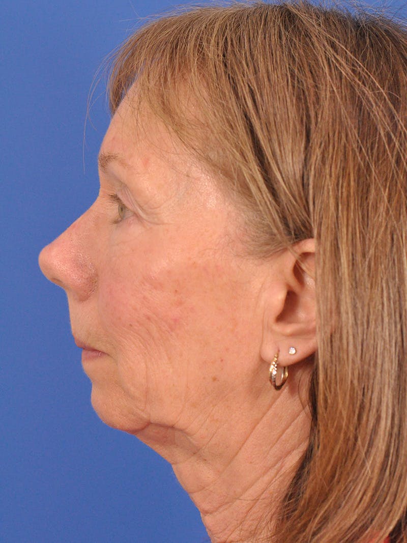 CO2RE Laser Before & After Gallery - Patient 425924 - Image 9