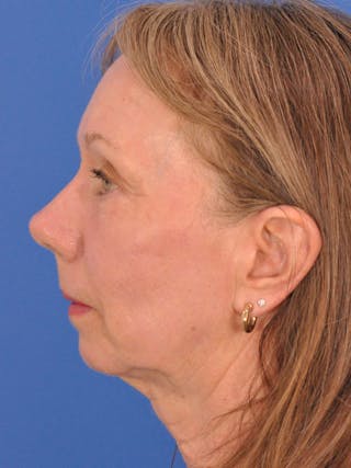 CO2RE Laser Before & After Gallery - Patient 425924 - Image 10