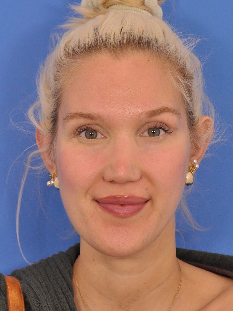Rhinoplasty Before & After Gallery - Patient 286948 - Image 4