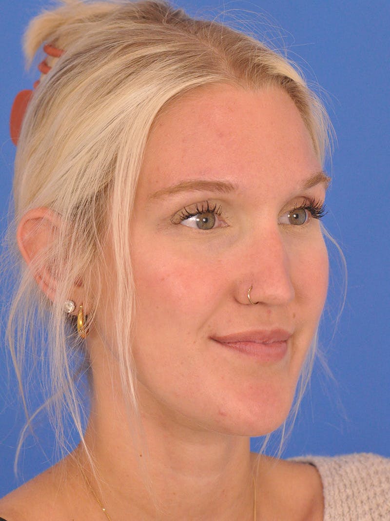 Rhinoplasty Before & After Gallery - Patient 286948 - Image 5