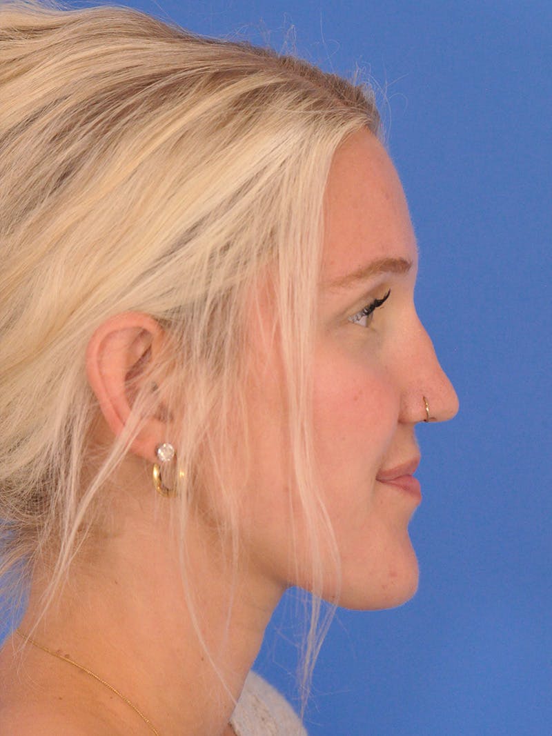 Rhinoplasty Before & After Gallery - Patient 286948 - Image 1