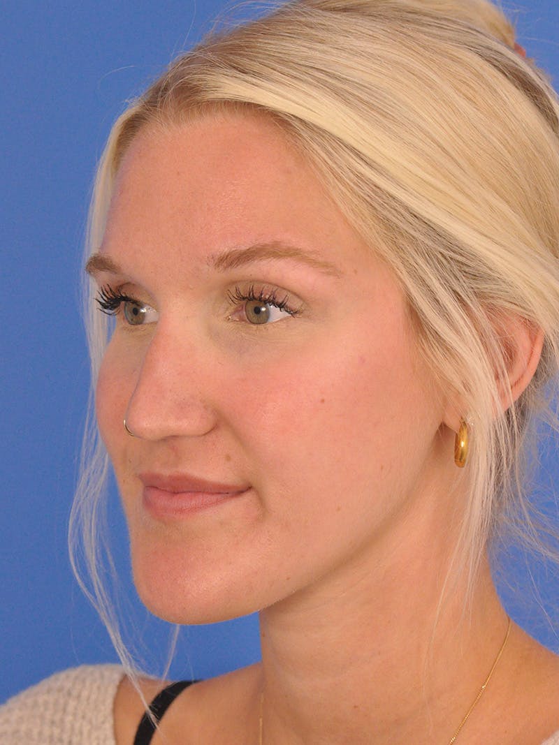 Rhinoplasty Before & After Gallery - Patient 286948 - Image 7