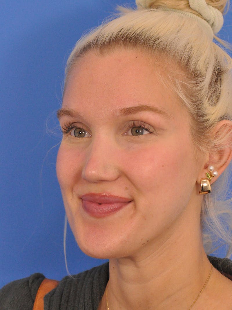 Rhinoplasty Before & After Gallery - Patient 286948 - Image 8