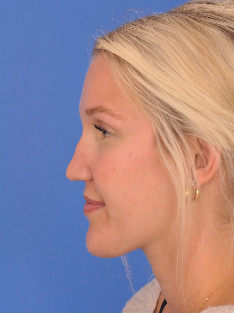 Rhinoplasty Before & After Gallery - Patient 286948 - Image 11