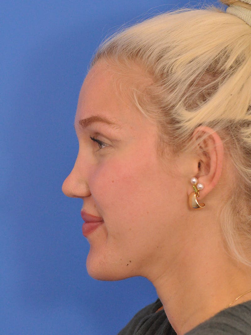 Rhinoplasty Before & After Gallery - Patient 286948 - Image 12