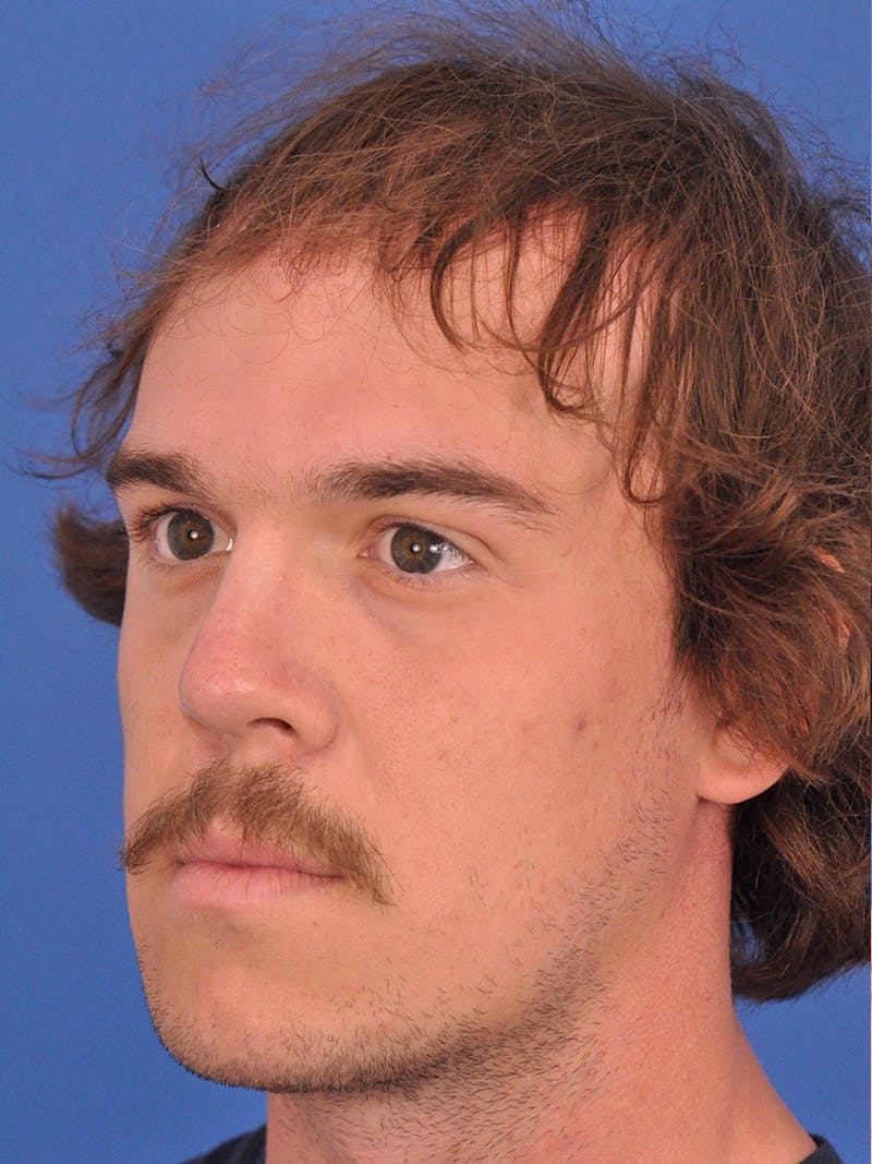 Rhinoplasty Before & After Gallery - Patient 394107 - Image 8