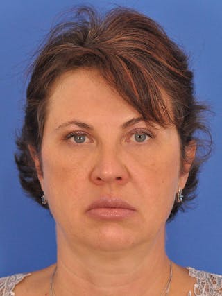 Profound Laser Before & After Gallery - Patient 269138 - Image 2