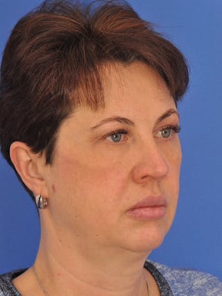 Profound Laser Before & After Gallery - Patient 269138 - Image 4