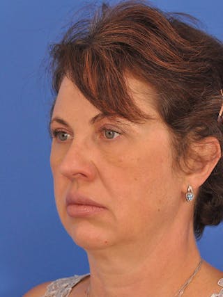 Profound Laser Before & After Gallery - Patient 269138 - Image 6