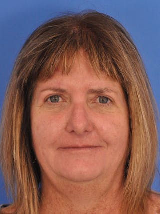 Blepharoplasty Before & After Gallery - Patient 184314 - Image 2