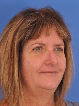 Blepharoplasty Before & After Gallery - Patient 184314 - Image 4