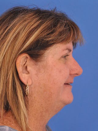 Blepharoplasty Before & After Gallery - Patient 184314 - Image 6
