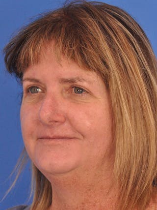 Blepharoplasty Before & After Gallery - Patient 184314 - Image 8