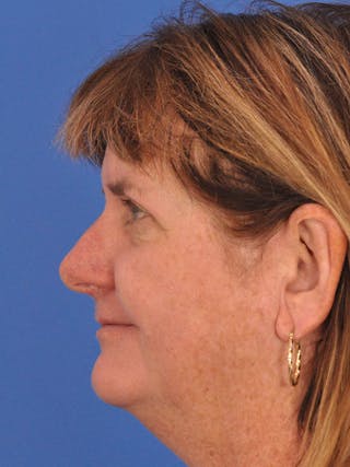 Blepharoplasty Before & After Gallery - Patient 184314 - Image 10