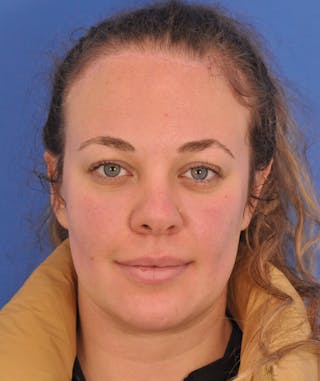 Forehead Reduction Before & After Gallery - Patient 658691 - Image 2