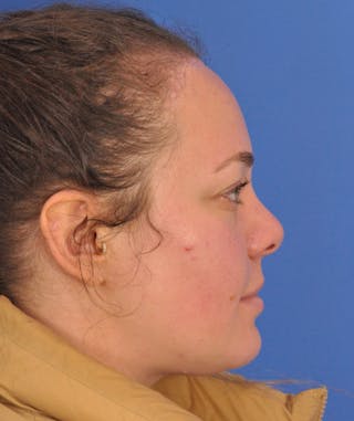 Forehead Reduction Before & After Gallery - Patient 658691 - Image 4