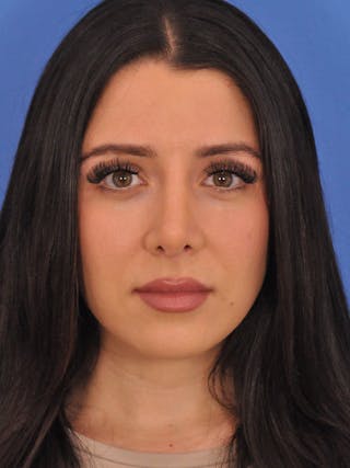 Rhinoplasty Before & After Gallery - Patient 909952 - Image 6