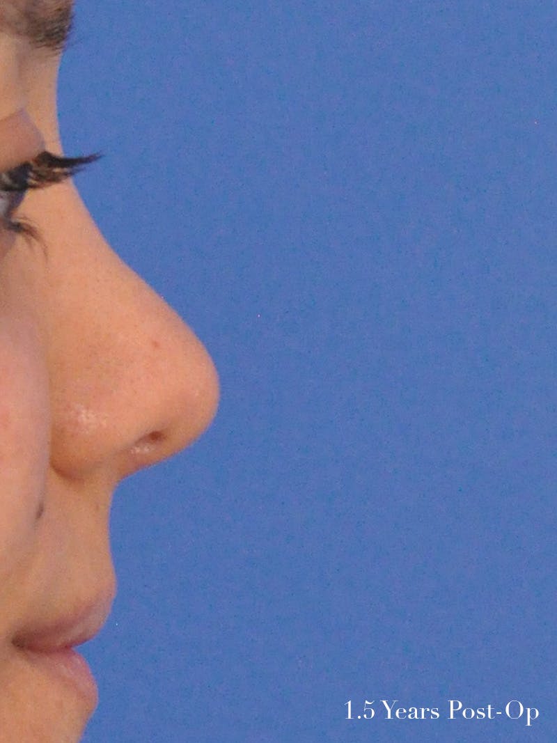 Rhinoplasty Before & After Gallery - Patient 951602 - Image 5