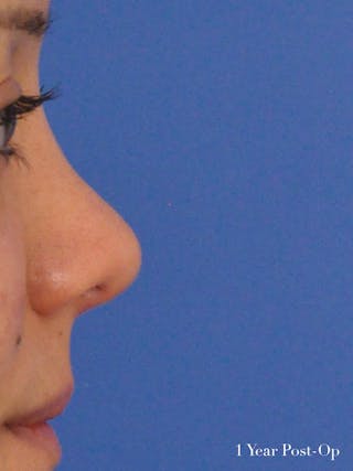 Rhinoplasty Before & After Gallery - Patient 951602 - Image 4