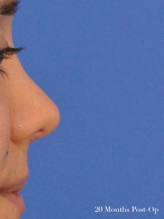 Rhinoplasty Before & After Gallery - Patient 951602 - Image 6