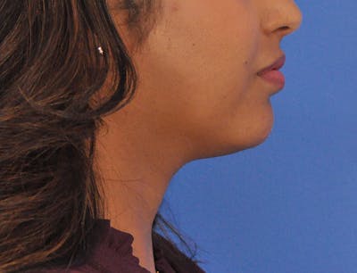 Chin Filler Before & After Gallery - Patient 297798 - Image 1