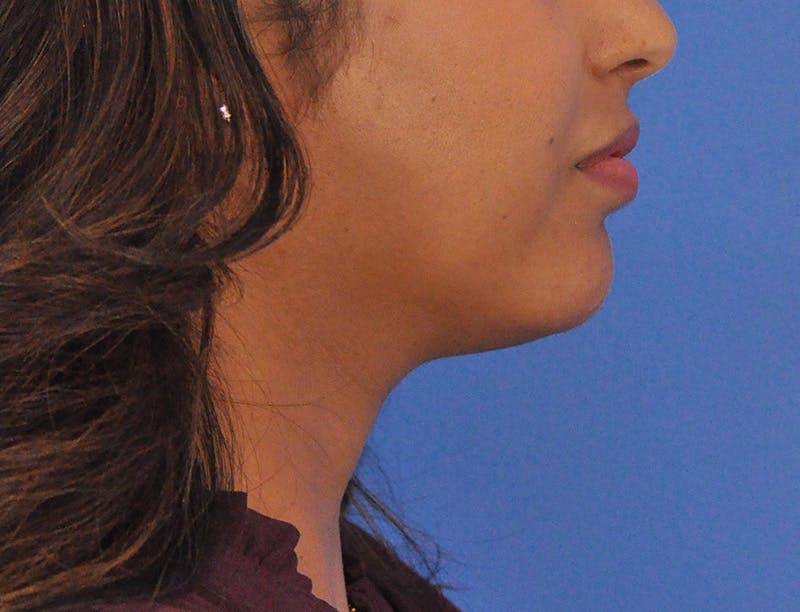 Chin Filler Before & After Gallery - Patient 297798 - Image 1